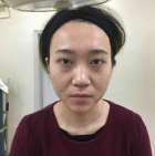 我发现眼睛朝上看的时候，下眼皮已经平了