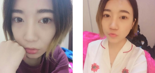 我发现眼睛朝上看的时候，下眼皮已经平了