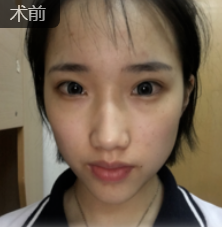 面部改变这般大，除了丰满就是年轻