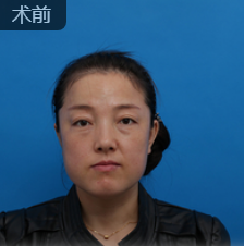 前两天说的那个眼睛的浮肿情况很快就平定下来了