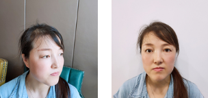 前两天说的那个眼睛的浮肿情况很快就平定下来了