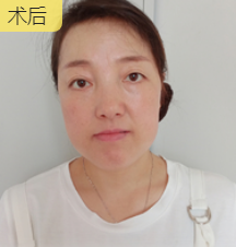 前两天说的那个眼睛的浮肿情况很快就平定下来了
