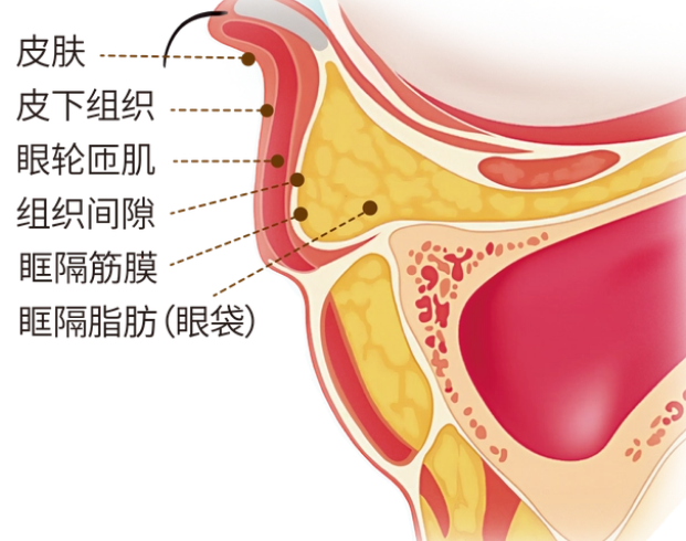 脂肪疝出，且松弛皮肤在下睑的堆积