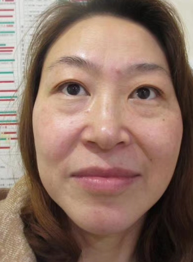 眼袋也影响眼部正常的健康
