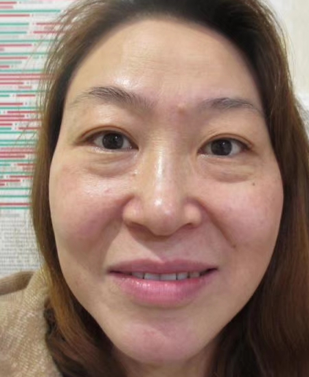 眼袋也影响眼部正常的健康