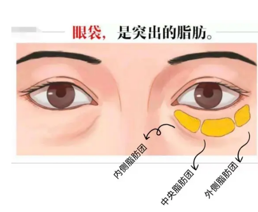 眼袋也影响眼部正常的健康