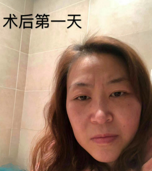 眼袋也影响眼部正常的健康
