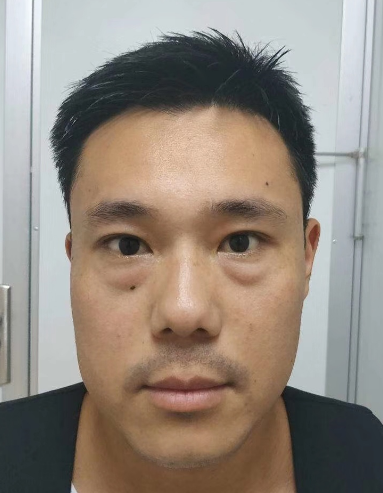 眼睑很平整，再也没有难看的眼袋了!