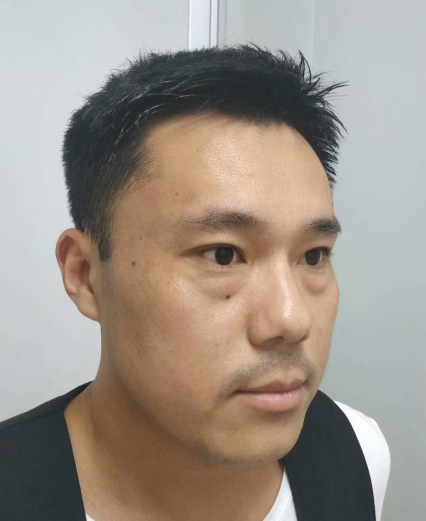 眼睑很平整，再也没有难看的眼袋了!