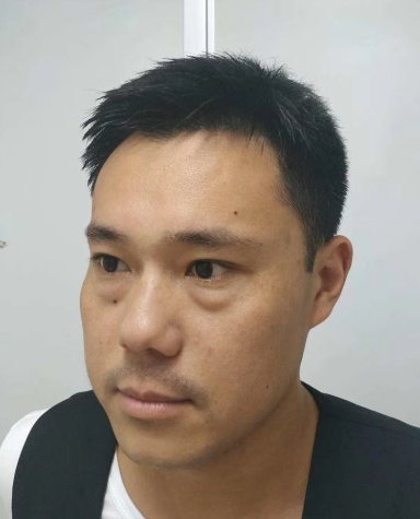 眼睑很平整，再也没有难看的眼袋了!