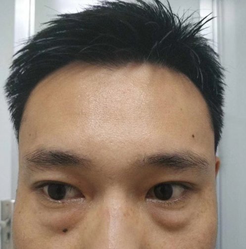 眼睑很平整，再也没有难看的眼袋了!