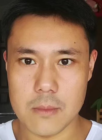 眼睑很平整，再也没有难看的眼袋了!