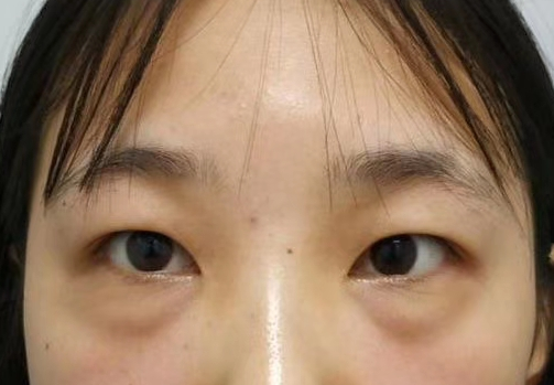 暴露年龄的眼袋可以温和的解决吗？