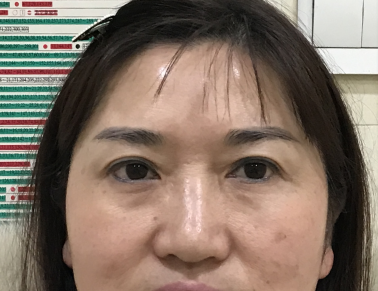睑下的鼓包明显也是在预料之内的