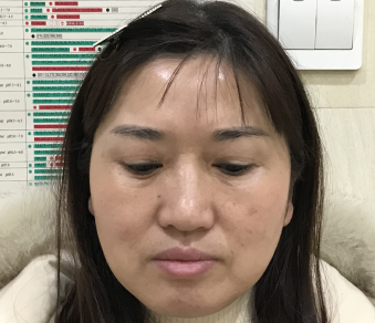 睑下的鼓包明显也是在预料之内的