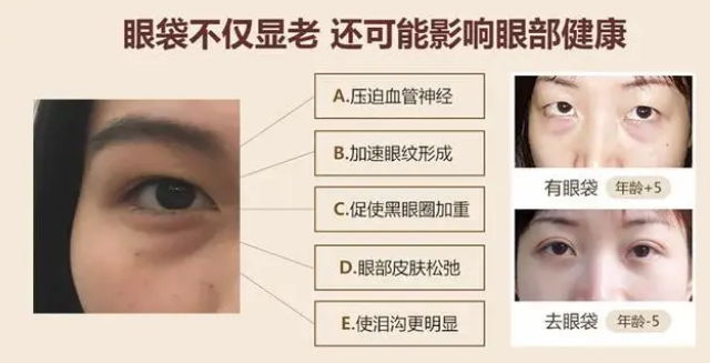 睑下的鼓包明显也是在预料之内的