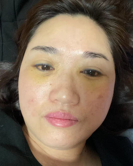 睑下的鼓包明显也是在预料之内的