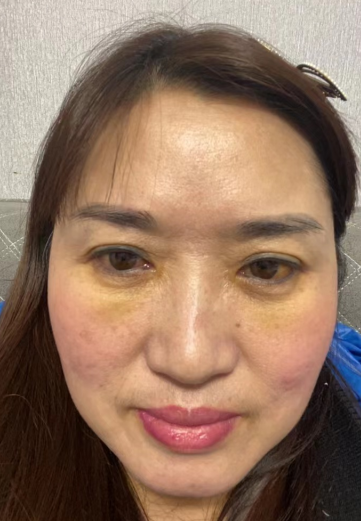 睑下的鼓包明显也是在预料之内的