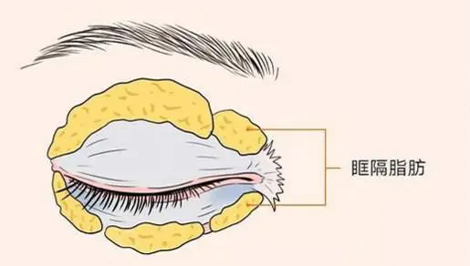 去眼袋7天就非常非常自然的